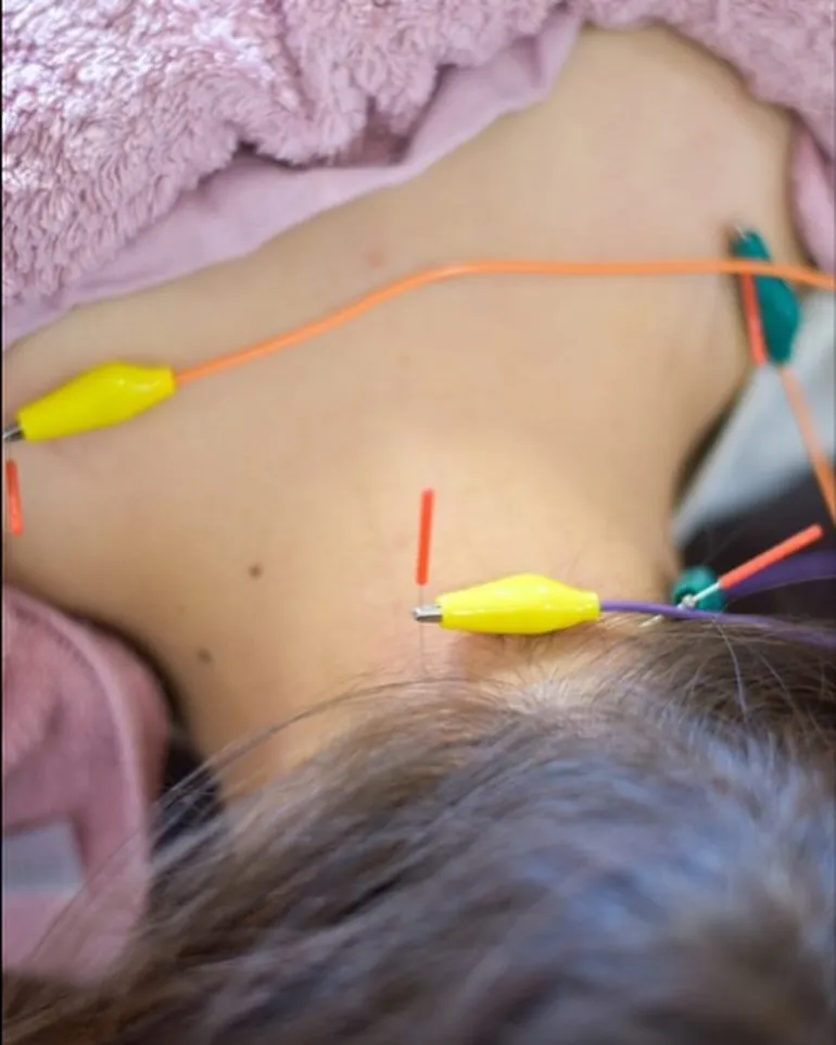 🌿【整骨院でできる鍼灸治療】🌿