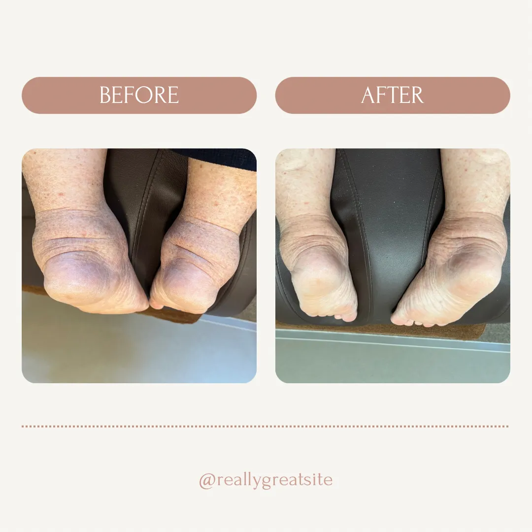 【高齢者のむくみ対策】脚が軽くなる整骨院のケアとは